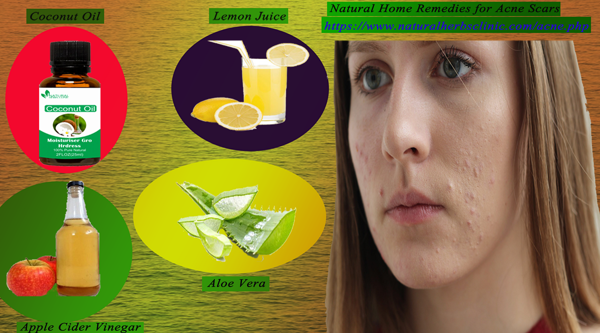 Home Remedies for Acne Scars