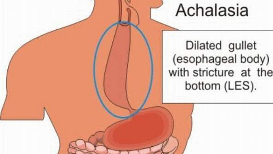 Achalasia: An Uncommon Infection