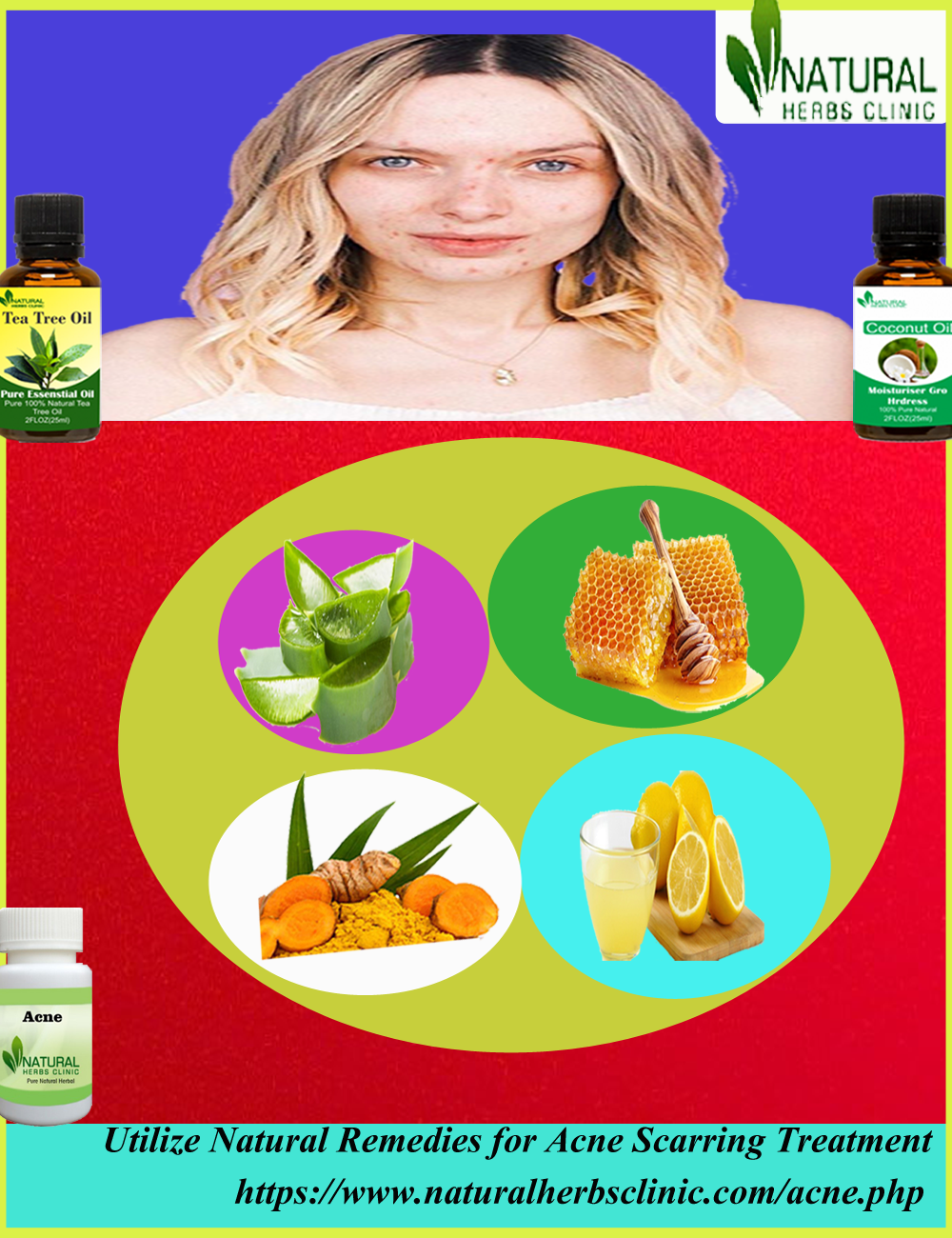 Utilize Natural Remedies for Acne Scarring Treatment