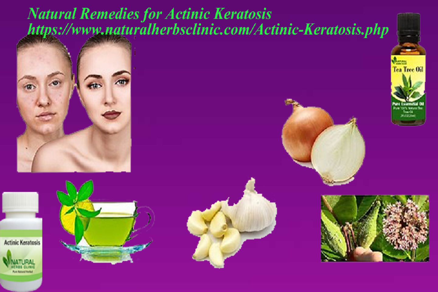 Natural Remedies for Actinic Keratosis