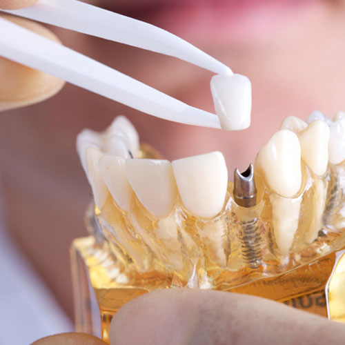 Achieving a Radiant Smile: The Comprehensive Guide to Ashburn Dental Implants