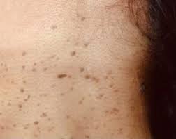 Best Way of Laser Hair Removal