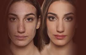 Treatment And Causes Of Pimples 