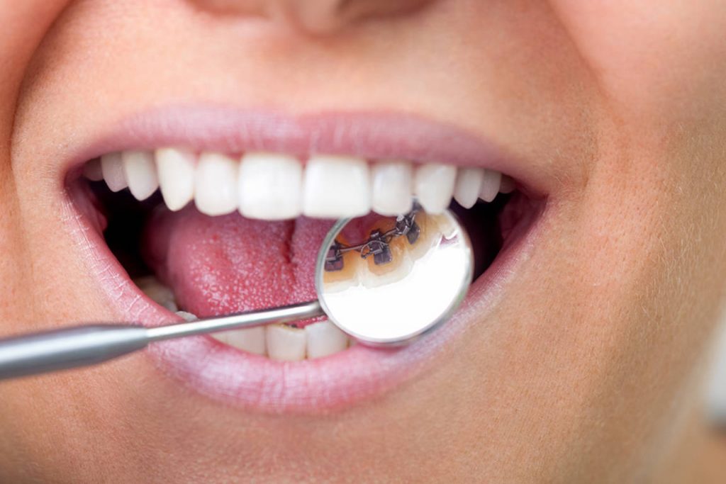 Types Of Invisible Braces