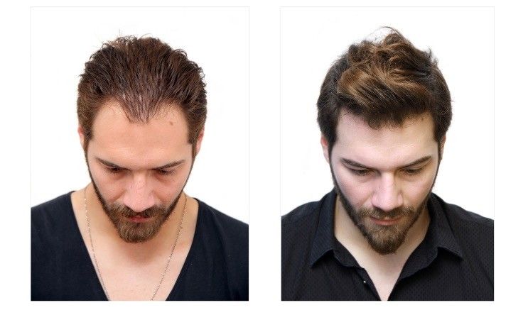 Which Type Of Hair Transplant Is Right For You?