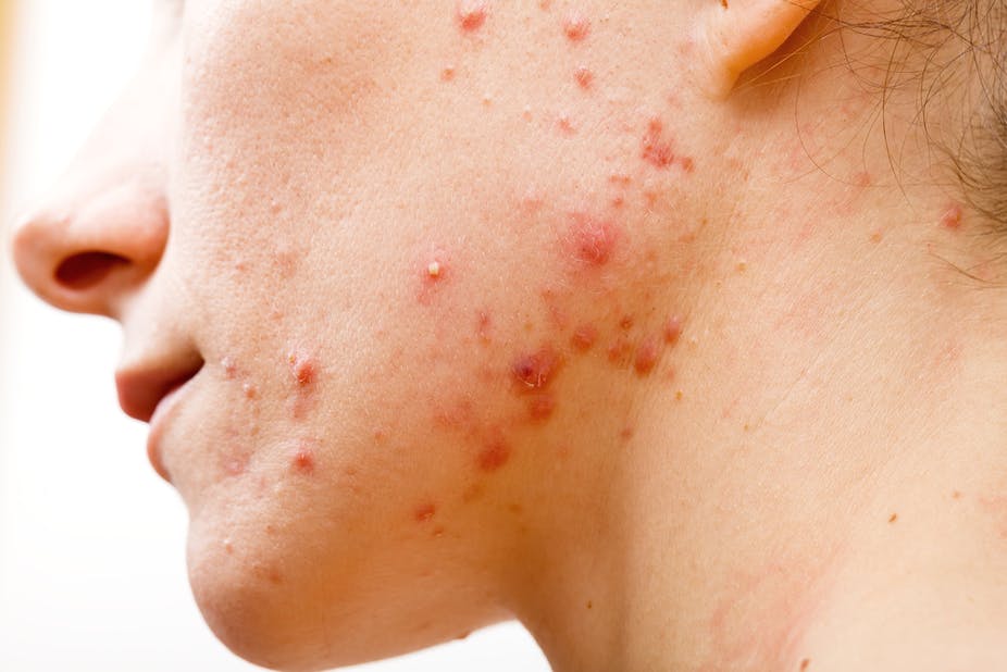 Acne Treatment Types And Causes