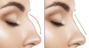 Nose Reshaping procedure