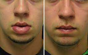 Lip Reduction Surgery