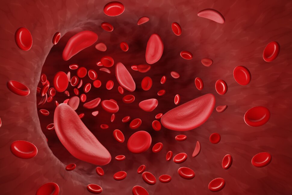 Sickle Cell Disease Treatment Market Insight | Outlook | Growth Analysis Report 2030