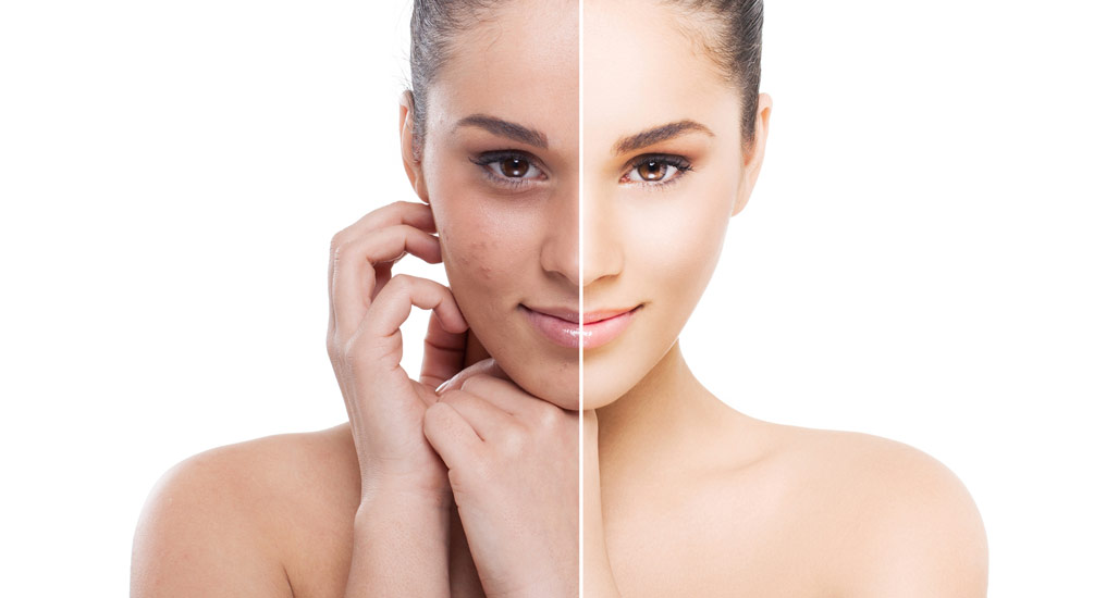 Hollywood Peel Facial in Richmond Hill