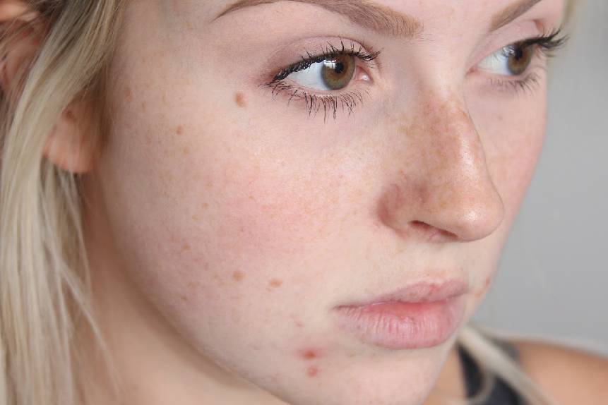 best acne treatment in delhi