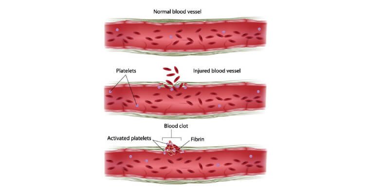 What is Bleeding & Clotting Disorders | Dr. Atish Bakane