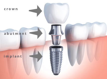 Why Dental Implants Are Worth It