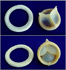 Tissue Heart Valve Materials Market Drivers, Restraints and Challenges Analysis Report 2021-2027