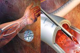 Vascular Patches Market Size, Status, Growth | Industry Analysis Report 2020-2028