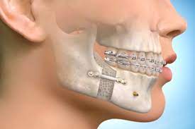 Jaw Surgery Market Size, Status, Growth | Industry Analysis Report 2020-2028