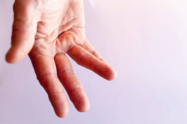 How Can Massage Therapy Help Dupuytren's Contracture?