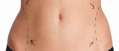 LIPOSUCTION TREATMENT