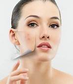 IS LASER TREATMENT FOR ACNE SCARS PERMANENT?