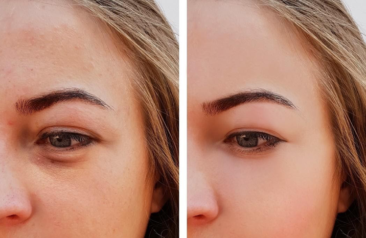 Get Upper Eyelid Surgery with  Dr. Sean Yuan | Aesthetic and Bariatrics