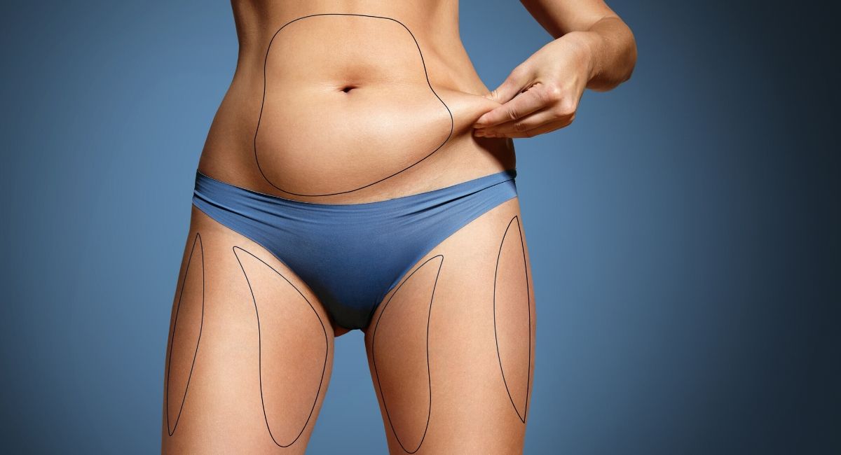 Get the Best Liposuction Procedure | Aesthetic and Bariatrics