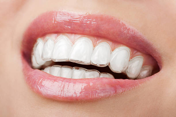 Invisalign Aligners: Advantages and Limitations You Need to Know