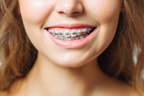 What is the Difference Between Ceramic and Traditional Braces?