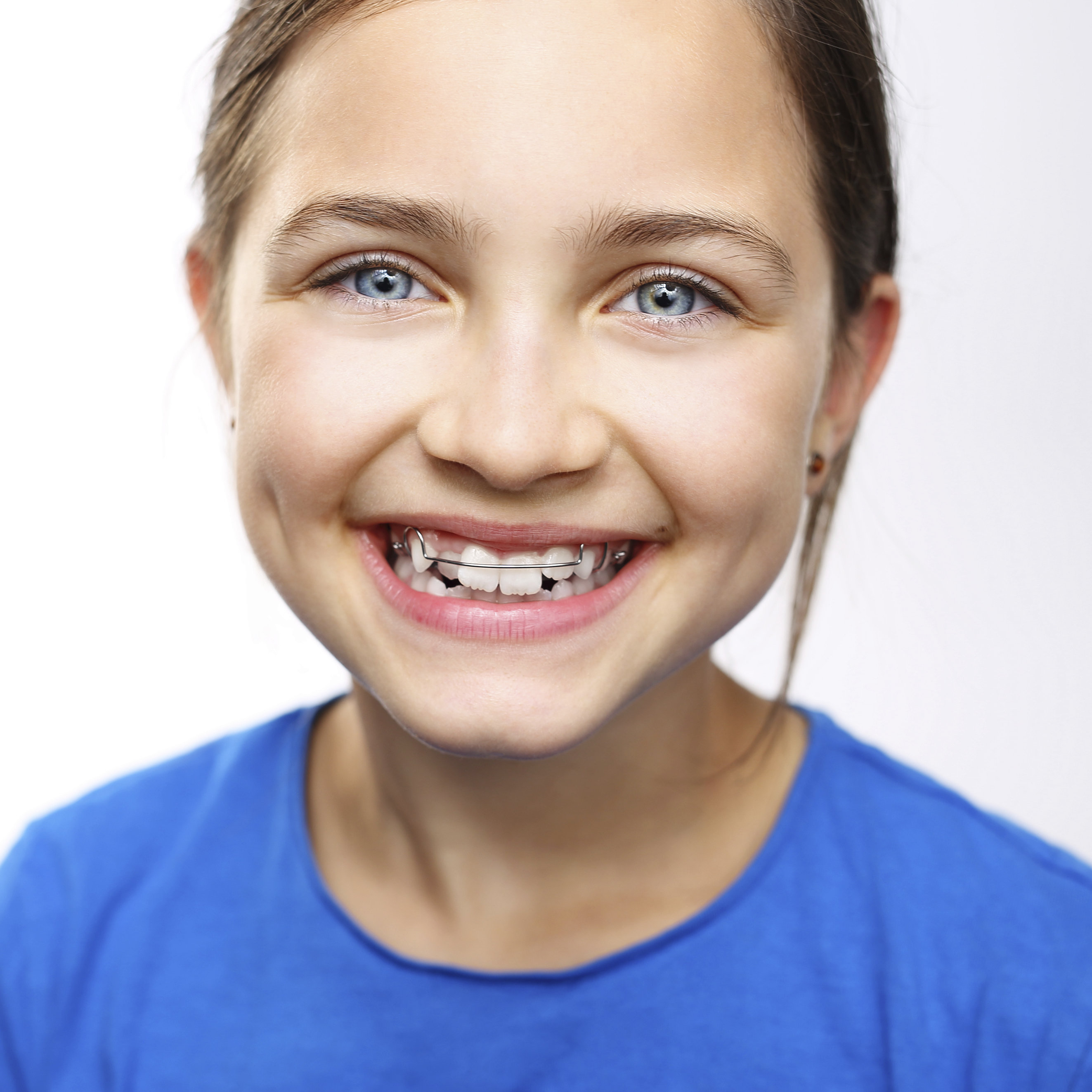 How Much Does Invisalign In Calabasas Cost To You?