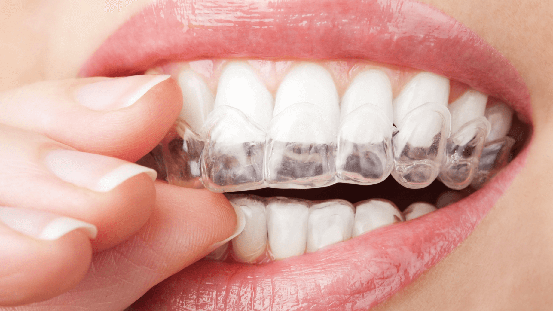What Are the Options Available for Teeth Alignment?