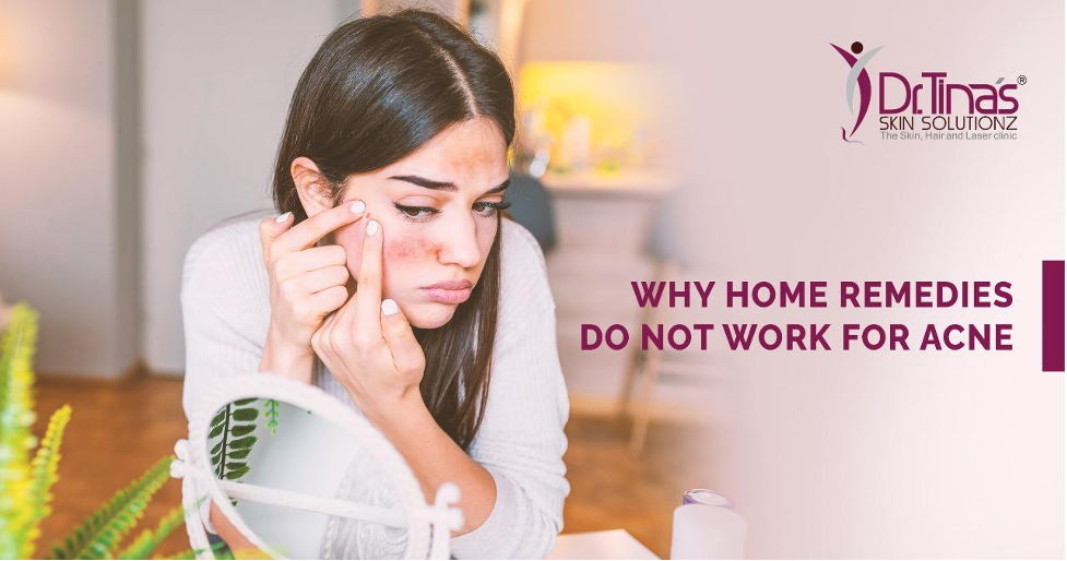 Why Home Remedies May Not Work for Acne 