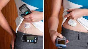 Tubeless Insulin Pump Market 2022 Size, Growth Factors & Forecast Report