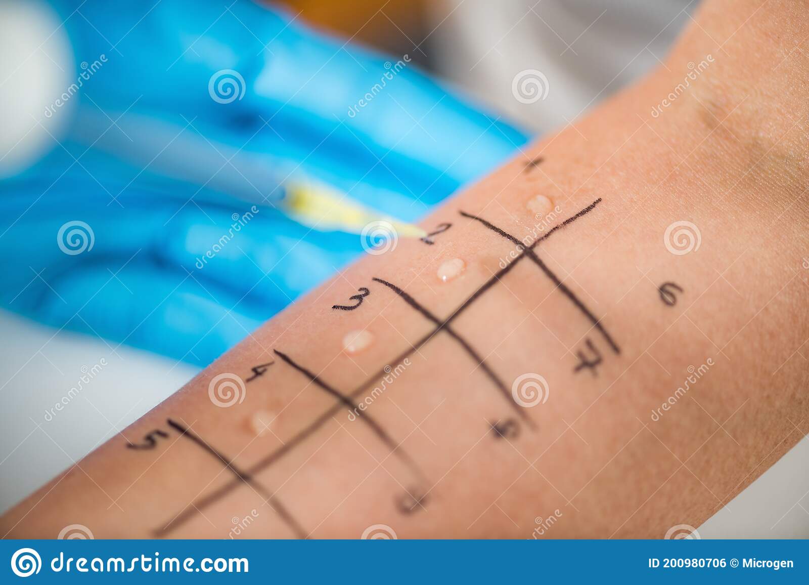 All You Really want To Be familiar with Skin Testing for Sensitivities