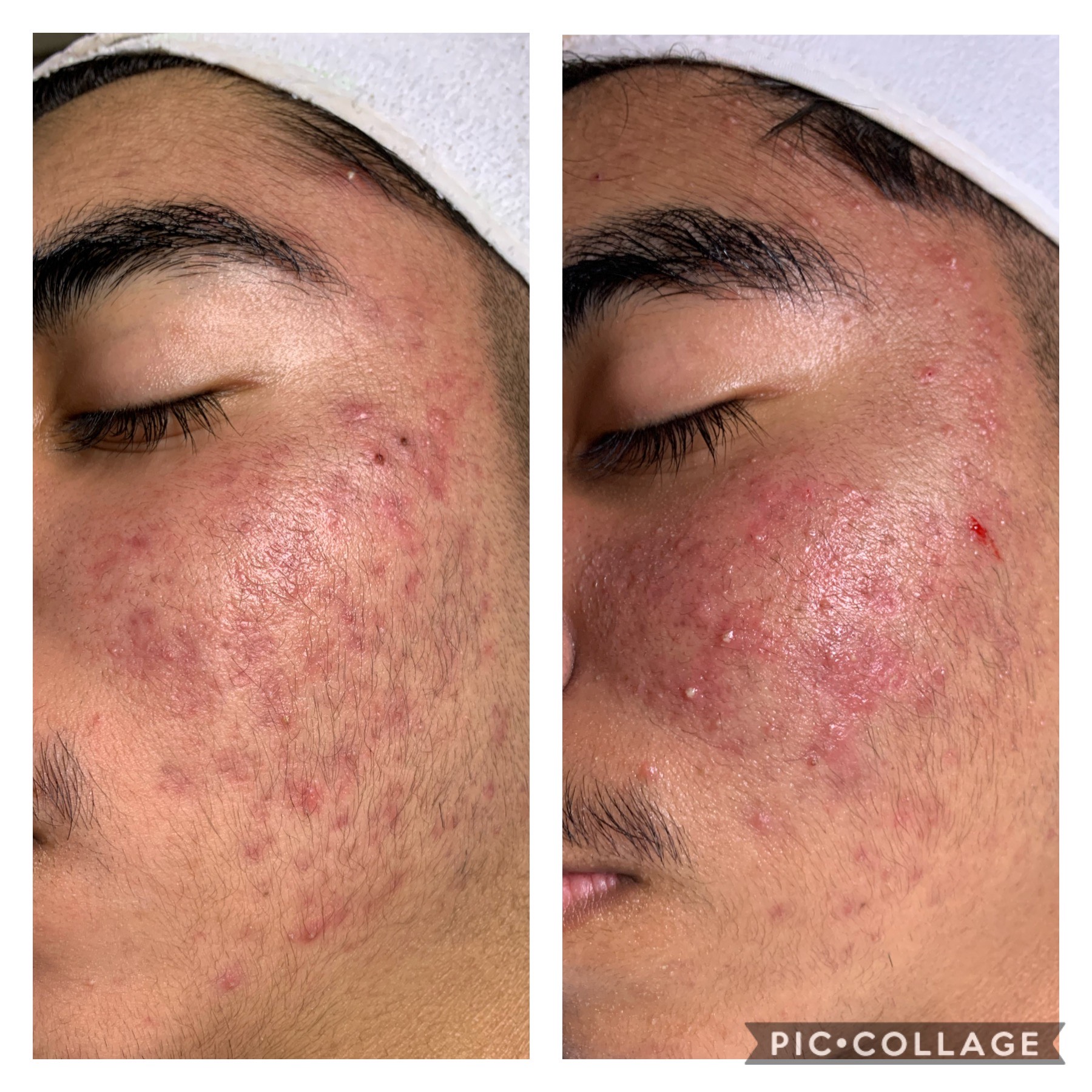 How to treat the problem of Acne and Ageing? Simple Step Explanation!