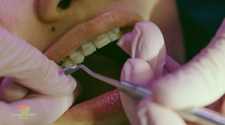 Cosmodentindia For Braces Treatment in Gurgaon