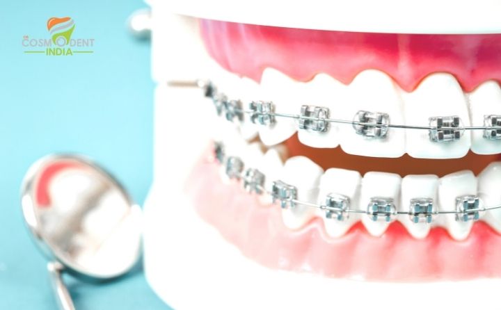 CosmodentIndia For Lowest Teeth Braces Cost in India