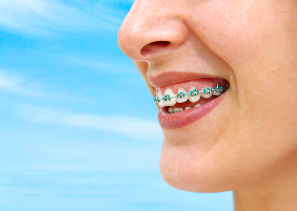 The Advantages of Braces for Good Health