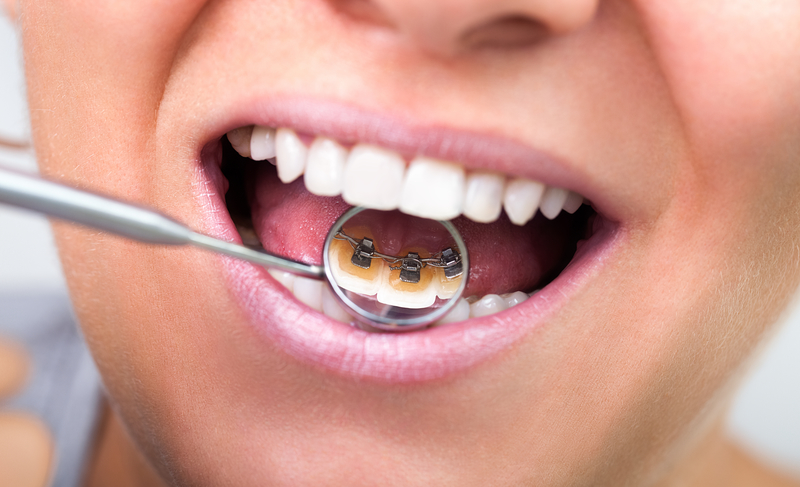 What Other Advantages Do Braces Have Besides Straightening Teeth?