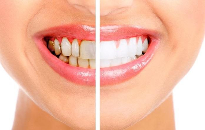 Facts about Teeth Whitening Everyone Should Know