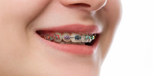 Why More Adults Are Choosing Orthodontic Treatment