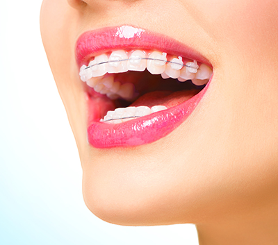 Why Should You Choose Invisalign?