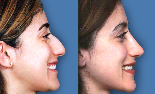 How Painful Is A Chin Implant?