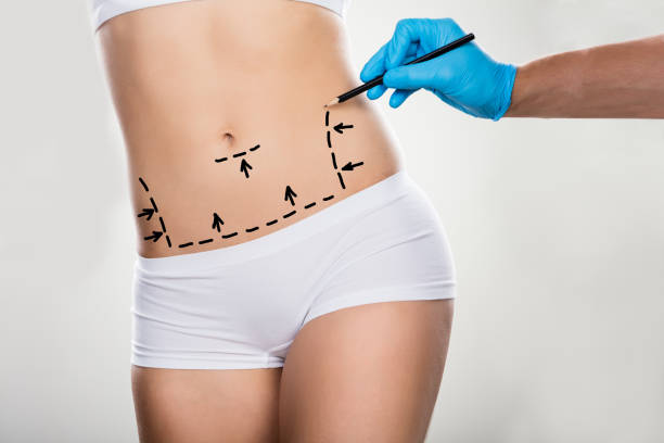 What is The Maximum Amount of Fat Removed in A Tummy Tuck?