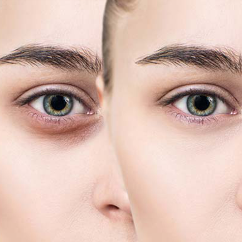 Reverse your dark circles under the eyes by understanding the real cause!!