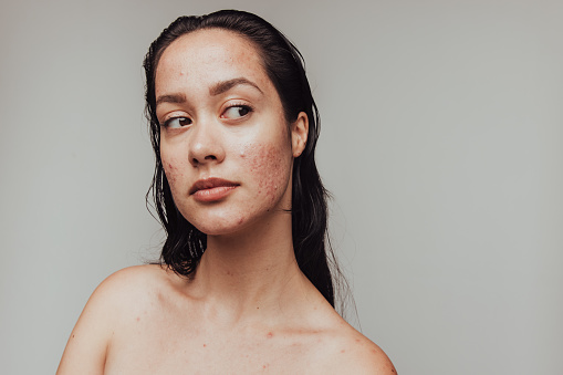 All you need to know about acne and their treatment 