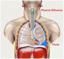  Pleural Effusions Treatment Market Size, Drivers, Restraints Challenges, and Growth Opportunities Till 2028