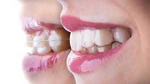Invisalign Advantages Over Traditional Braces