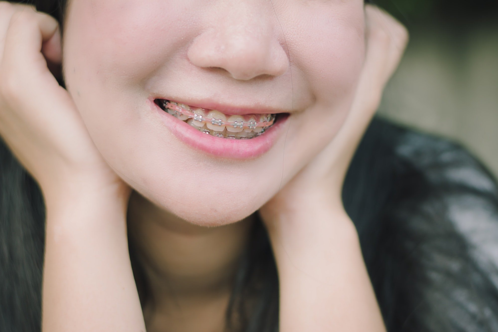 Long-term Benefits of Braces 