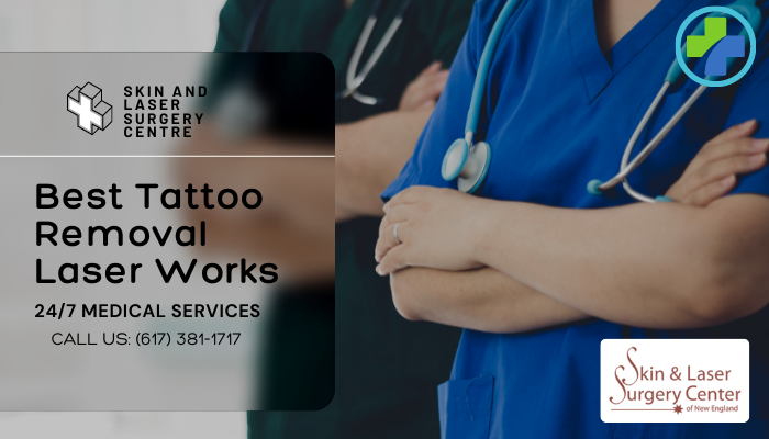 How Tattoo Removal Laser Works