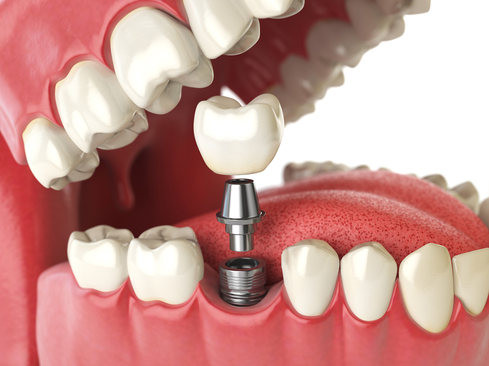Dental Implants Are a Food Alternative to Dentures