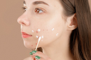 How To Navigate Acne With Confidence